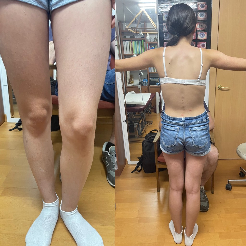 Tendinopatía rotuliana