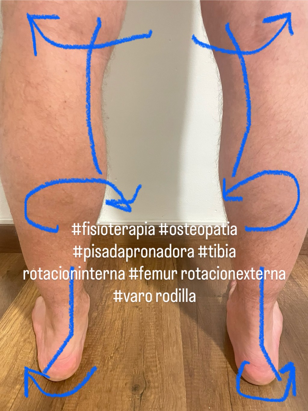 Ondas de choque fascitis plantar