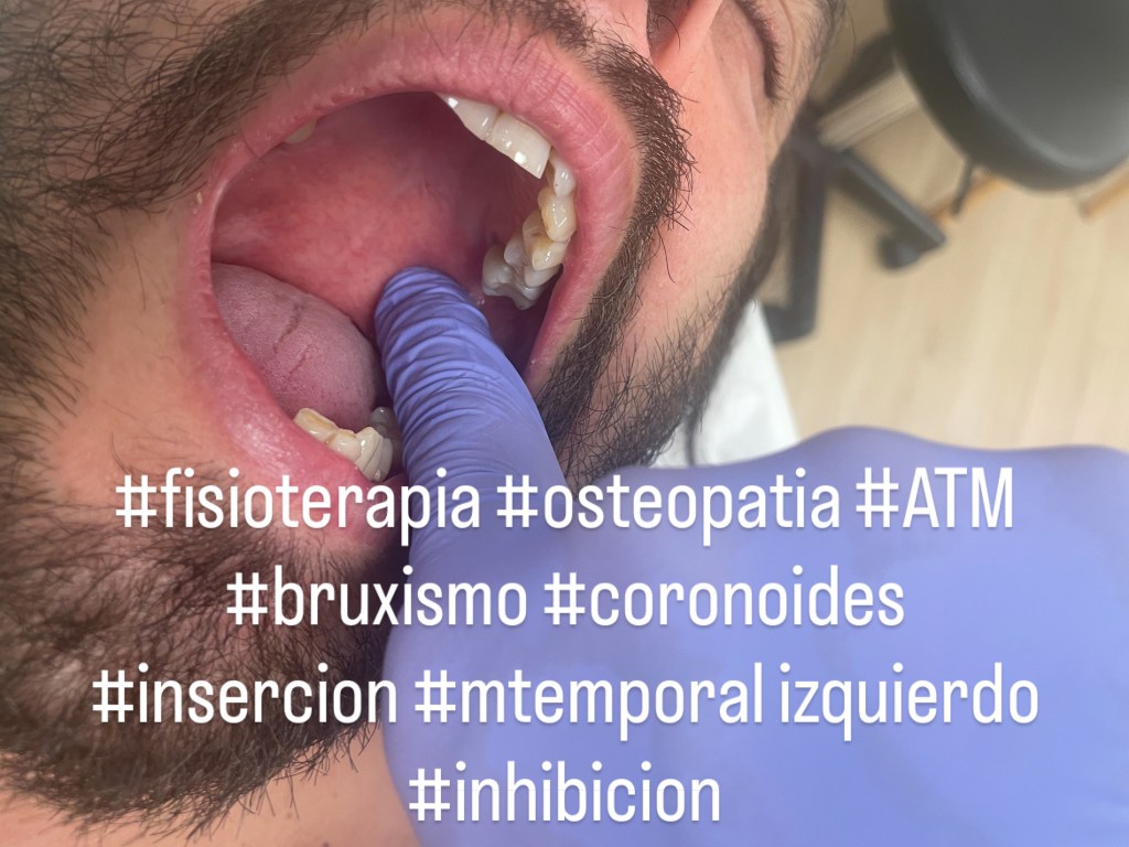 ATM y Bruximo. Articulación Temporo Mandibular.