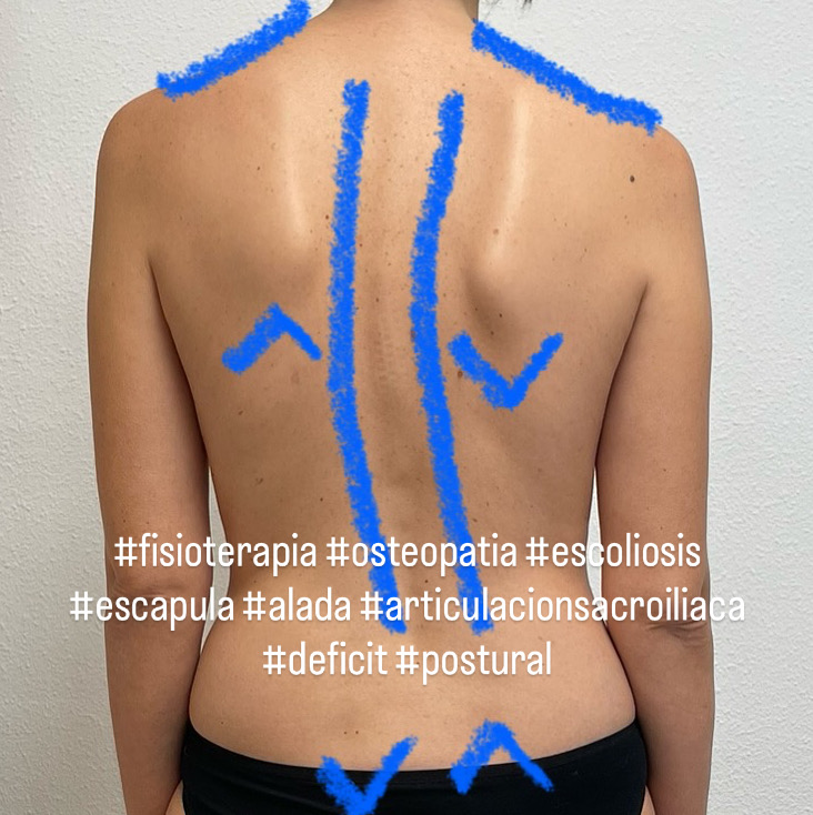 Dolor lumbar Barcelona y Pineda de Mar Maresme