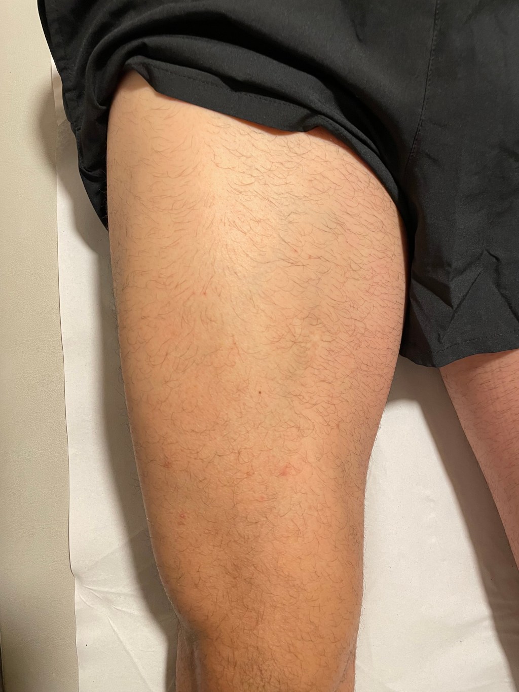 ondas de choque dolor trocantérico